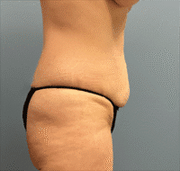 Tummy Tuck