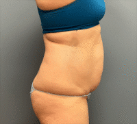 Tummy Tuck