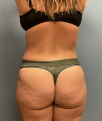 Tummy Tuck
