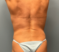 Upper Back/Bra Line Lift