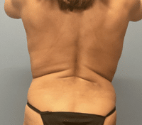 Upper Back/Bra Line Lift