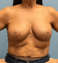 Breast Lift