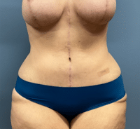 Tummy Tuck