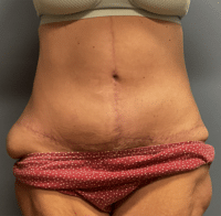 Tummy Tuck