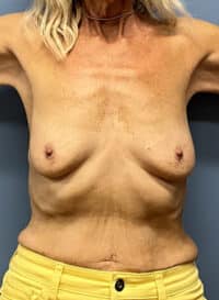 Breast Lift with Augmentation