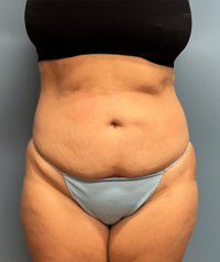 Tummy Tuck