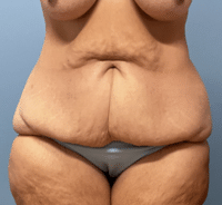 Tummy Tuck