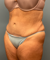 Tummy Tuck