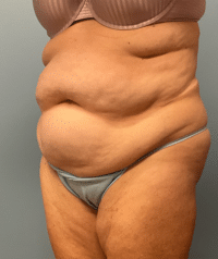 Tummy Tuck