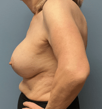 Breast Lift with Augmentation