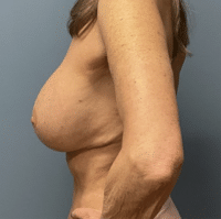 Revision Reconstruction