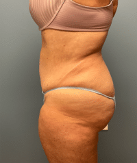 Tummy Tuck