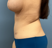 Tummy Tuck