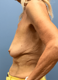 Breast Lift with Augmentation
