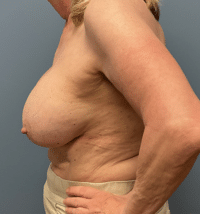 Breast Lift with Augmentation