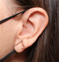 Earlobe Reduction