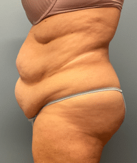 Tummy Tuck