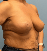 Breast Lift
