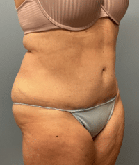 Tummy Tuck