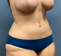 Tummy Tuck