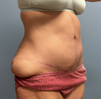 Tummy Tuck