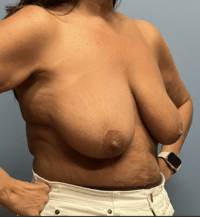 Breast Lift