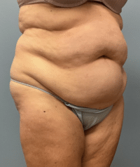 Tummy Tuck