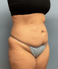 Tummy Tuck