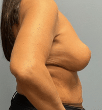 Breast Lift