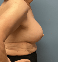 Breast Lift with Augmentation