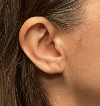 Earlobe Reduction