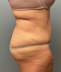 Tummy Tuck