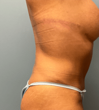 Upper Back/Bra Line Lift