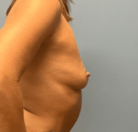 Breast Augmentation