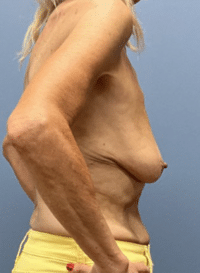 Breast Lift with Augmentation