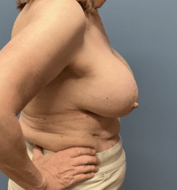 Breast Lift with Augmentation