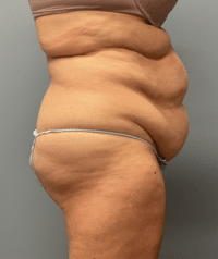 Tummy Tuck