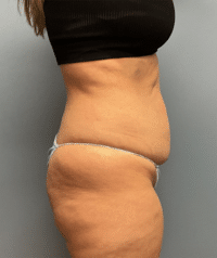Tummy Tuck
