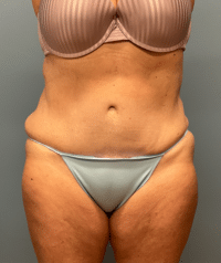 Tummy Tuck