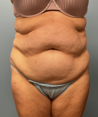Tummy Tuck